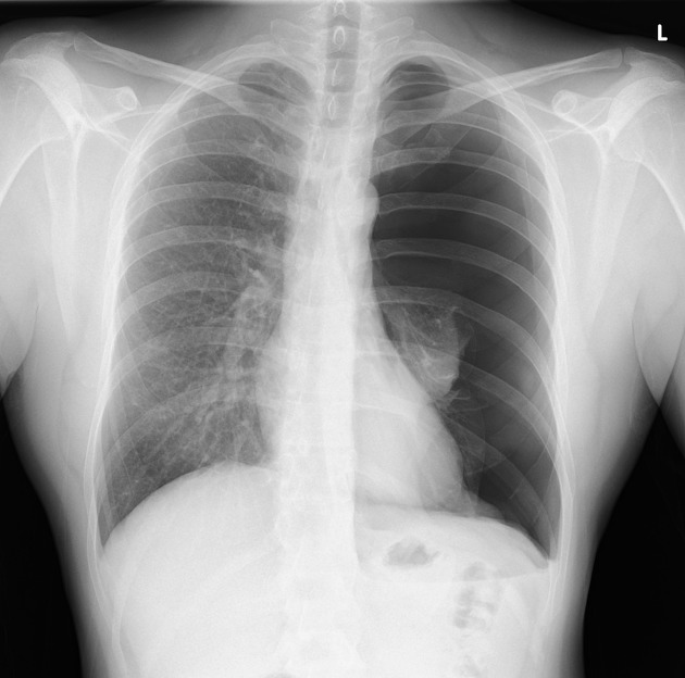 <p>What’s wrong with this CXR?</p>