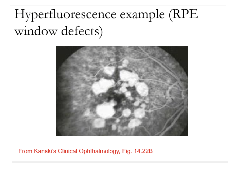 <p>1. Leakage: Fluorescein (and fluid) escaping from vessels due to breakdown of the blood–retinal barrier (e.g., DME, CNV, vasculitis).<br>2. RPE window defect: Decreased RPE pigment allows more choroidal fluorescence to shine through → increased background glow (not actual leakage).</p>