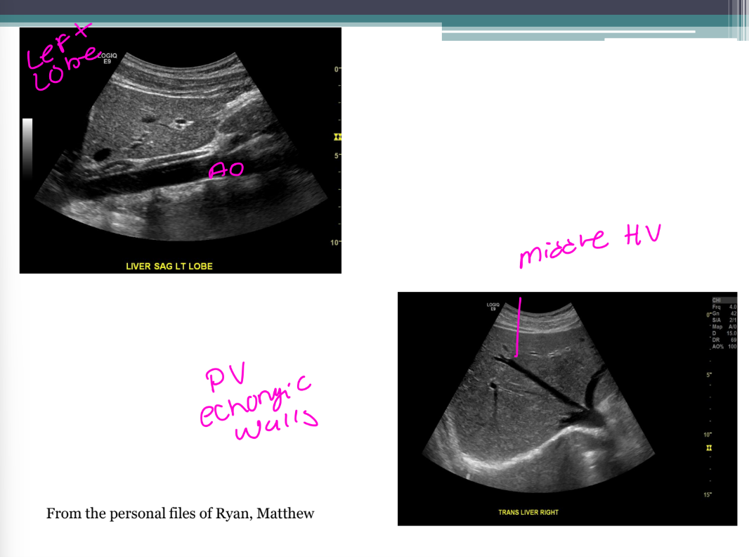 <ul><li><p>Homogeneous liver</p></li><li><p>Low-level echoes</p></li><li><p>Smooth borders</p></li><li><p>Intrahepatic vessels easily identified</p></li></ul><p></p>