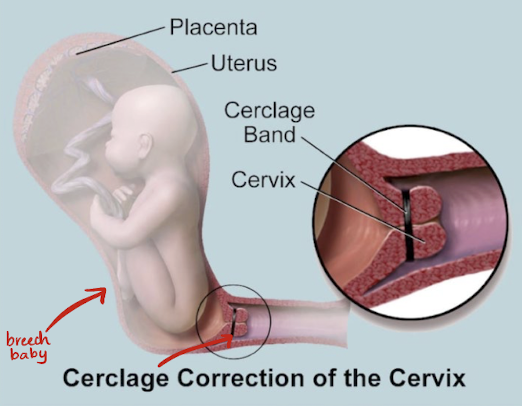 <ul><li><p><span style="color: yellow;">tx for cervical incompetence</span></p></li><li><p><span style="color: yellow;">cervix is stitched</span> closed to prevent preterm birth</p></li><li><p>cerclage removal:</p><ul><li><p>removed around 36-37 weeks GA for planned vaginal delivery OR</p></li><li><p>left in place and removed at time of planned cesarean delivery (c-section)</p></li></ul></li></ul><p></p>