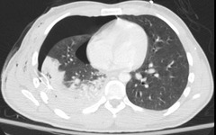 <p>D. Persistent pneumothorax</p><p>The answer is D. The chest CT shows a chest tube in place on the right, with incomplete reinflation of the lung. The left hemithorax is grossly normal, but there is a large right pulmonary contusion, as well as pneumothorax and small hemothorax on the right. The aorta appears intact (aortic injuries usually leak into the left hemithorax, not the right).</p>