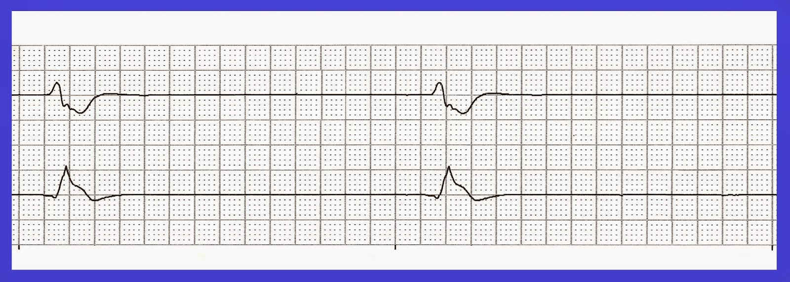 <p>Rate: <20 </p><p>Regularity: irregular </p><p>QRS < 0.12 </p>