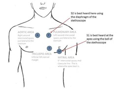 <p>Closure of mitral and tricuspid valves.</p>