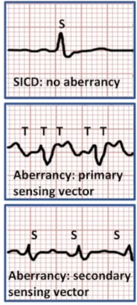 <ul><li><p>Transvenous ICD: morphology discriminator</p><ul><li><p>Patient exercising: sinus rate reaches VT zone</p></li><li><p>Morphology discriminator will label aberrancy as VT</p></li><li><p>Turn morphology off or turn on other discriminators</p></li></ul></li><li><p>SICD: subcutaneous ECG</p><ul><li><p>Aberrancy can cause R wave double-counting</p></li><li><p>Changes to T wave can cause T wave oversensing</p></li><li><p>Rate appears double</p></li><li><p>Change sensing vector</p></li></ul></li></ul><p></p>