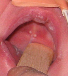 <p>The mother of a 2 month old baby has a concern of white nodules in the mouth of her kid. The clinical image is shown below. There is no pain or any other symptoms. Provide diagnosis</p>