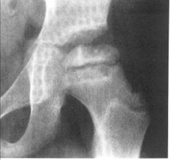 <p>Displacement of femoral head due to growth plate slippage.</p>