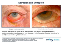 <p>Lid eversion</p><p>•Aggressive lubrication, artificial tears, gels, and ointments</p><p>•Surgical management if cornea becomes compromised from dryness and scarring.</p>