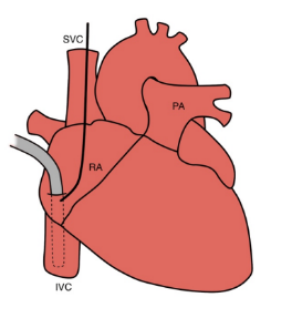 <p>Two-stage venous cannula because it does not involve opening the chambers of the heart</p>