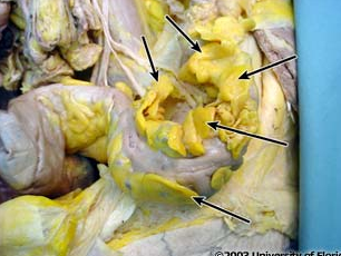 <p>what structure on the large intestine is this (be specfic)?</p>