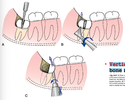 <p>more difficult for the mandibular</p><p>remove <span style="color: red;">occlusal, buccal, distal </span>bone</p><p>section <span style="color: red;">distal half of crown</span>; elevate remaining tooth <span style="color: red;">mesially</span></p><p>requires <span style="color: red;">more bone removal </span>due to limited access</p>