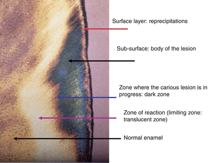 <ul><li><p>A white spot lesion contains different histological zones</p></li><li><p>From the enamel surface inward: </p></li></ul><ol><li><p><strong>Surface layer</strong>: Relatively intact (saliva remineralising/reprecipitating) </p></li><li><p><strong>Sub-surface/body of the lesion</strong>: Main demineralised mass </p></li><li><p><strong>Dark zone</strong>: Zone where the carious lesion is in progress </p></li><li><p><strong>Translucent zone</strong>: The deepest advancing part of the lesion, representing the early fron of demineralisation. </p></li></ol><p></p><ul><li><p>Therefore, the visible white spot is only the <strong>clinical sign</strong>. There is actually a larger subsurface demineralised lesion underneath. </p></li></ul><p></p>