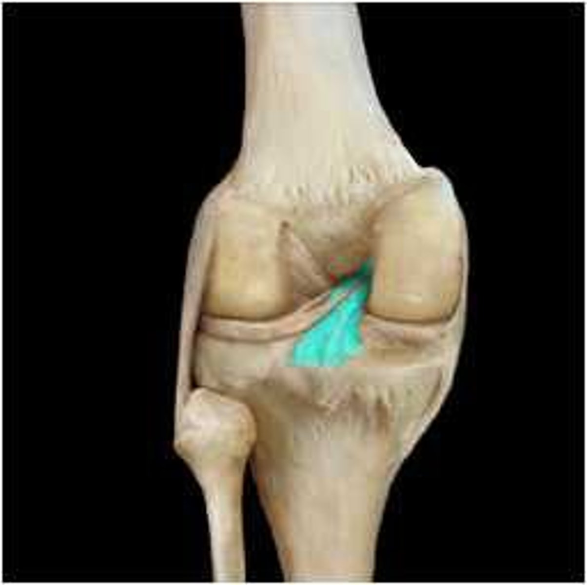 <p>Arises from the posterior intercondylar area of the tibia and passes anteriorly to attach to the femur on the lateral side of the medial condyle. The PCL prevents posterior displacement of the tibia on the femur and provides stability during flexion of the knee joint.</p>