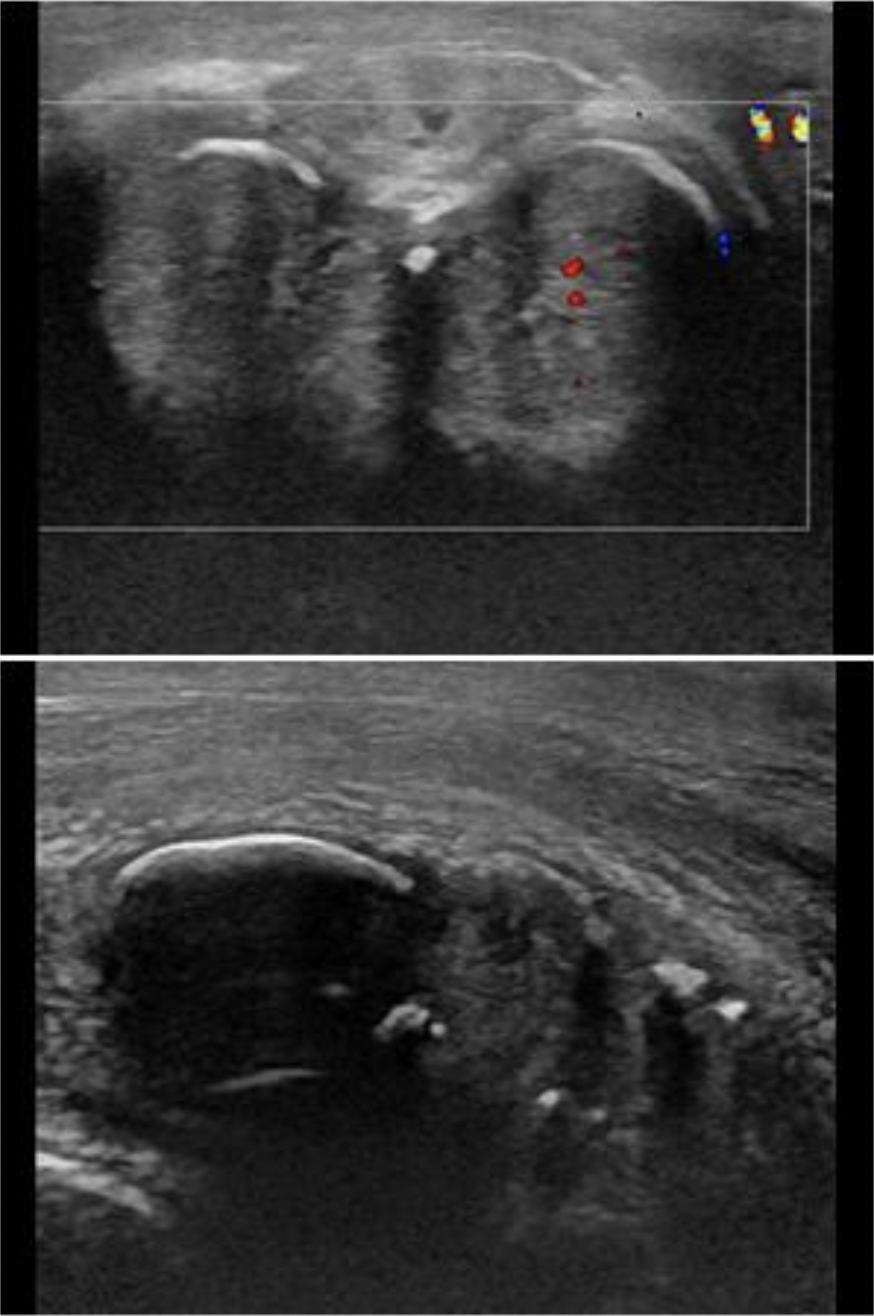 <p>The findings on the image are most suggestive of what penile abnormality?</p><p>A. Priapism</p><p class="p1">B. Penile cancer</p><p class="p1">C. Peyronie disease</p><p class="p1">D. Penile fracture</p>