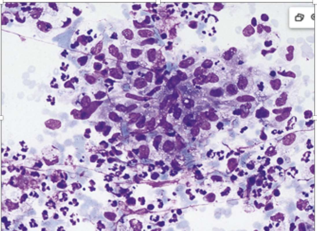 <p>cytologie ganglion lymphatique</p><ul><li><p>diagnostic </p></li></ul><p></p>