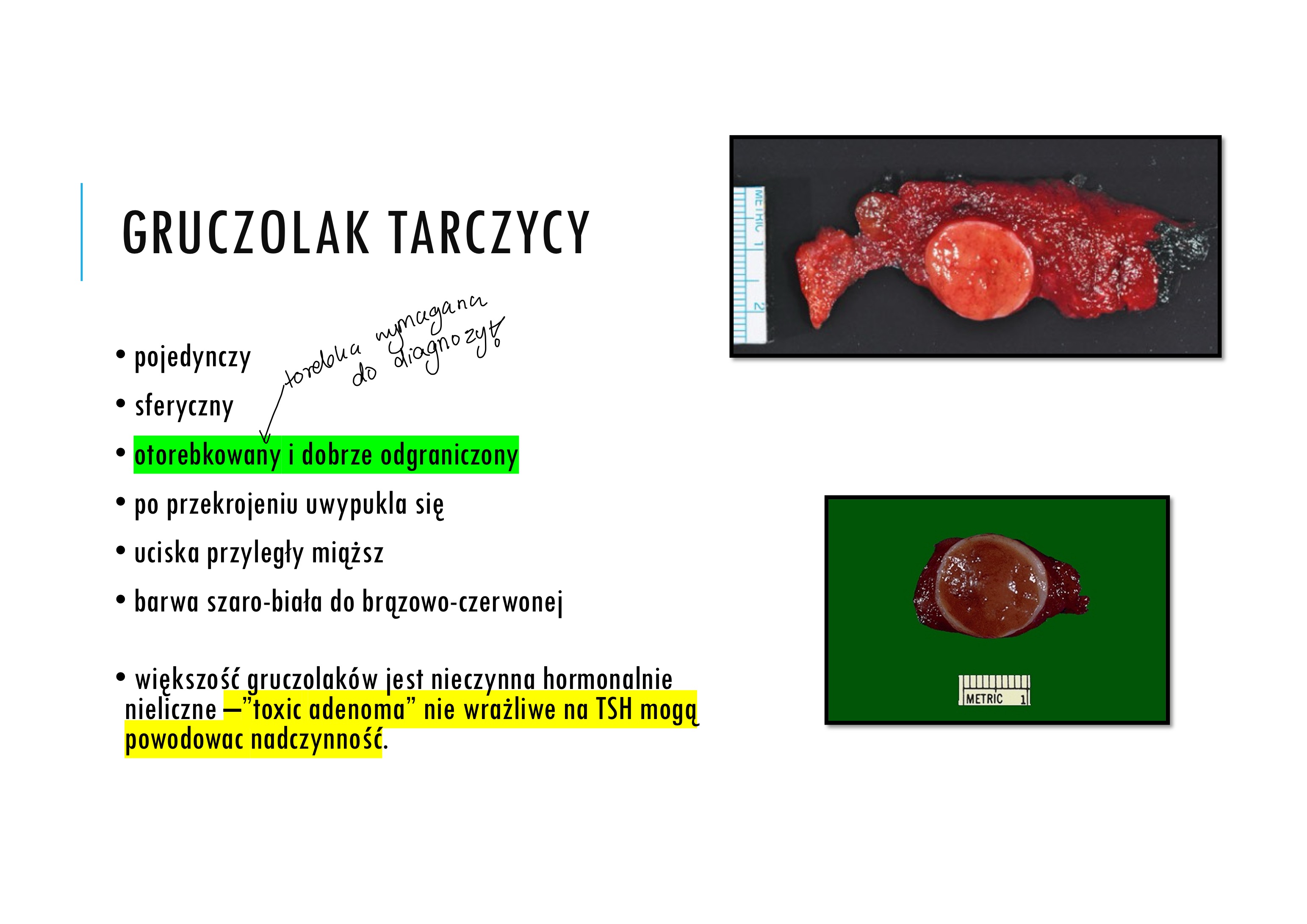 <p>• pojedynczy</p><p>• sferyczny</p><p>• otorebkowany i dobrze odgraniczony</p><p>• po przekrojeniu uwypukla się</p><p>• uciska przyległy miąższ</p><p>• barwa szaro-biała do brązowo-czerwonej</p><p>• większość gruczolaków jest nieczynna hormonalnie</p><p>nieliczne –</p><p>”toxic adenoma” nie wrażliwe na TSH mogą</p><p>powodowac nadczynność</p><p></p><p>Rozpoznanie gruczolaka można postawić</p><p>tylko na podstawie dokładnego</p><p>badania histologicznego usuniętej zmiany (!)</p>