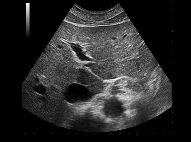 <p>Use your mouse to place your cursor over the center of the lateral left lobe of the liver and click to mark the structure. </p>