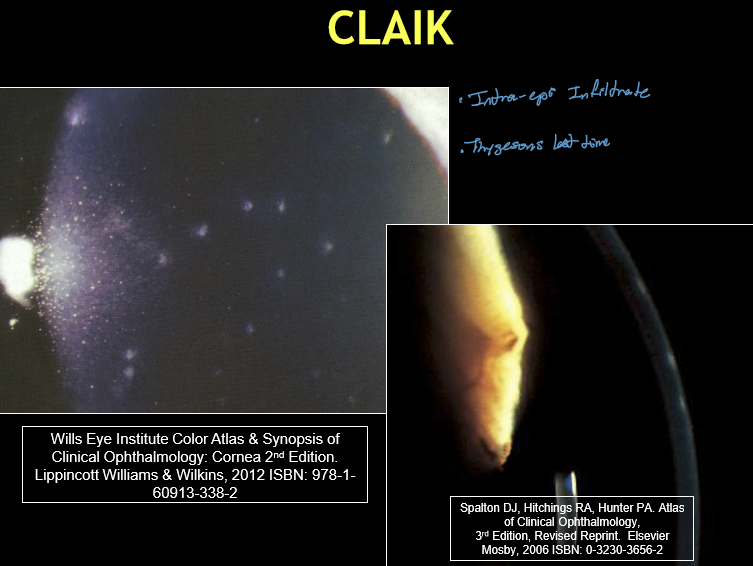 <ul><li><p>Asymptomatic to mild symptoms, including:</p><ul><li><p>Mild irritation</p></li><li><p>Tearing</p></li><li><p>Photophobia</p></li></ul></li><li><p>Conjunctival injection commonly present</p></li><li><p>Less painful than CLARE or microbial keratitis</p></li></ul><p></p>