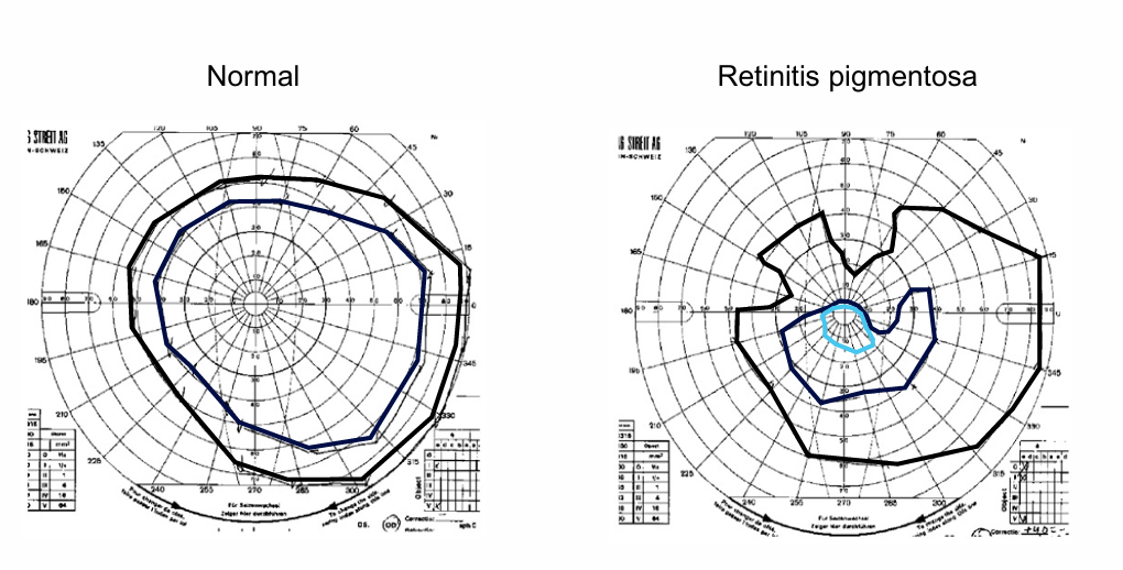 <p>retinal degenerations </p><ul><li><p>advance target of specific size and intensity inward until patient sees </p></li></ul><p></p>