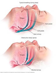 <p>No respiration and no tidal volume (TV).</p>