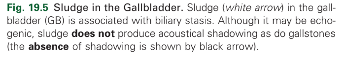 <p>Biliary sludge</p>