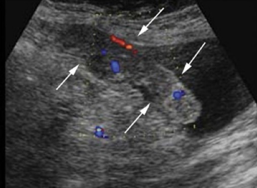 <p>thickening of greater omentum due to malignant infiltration</p>