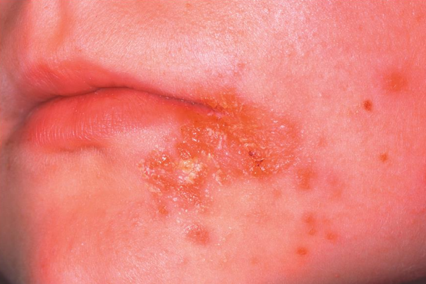 <ul><li><p><strong>Pathogen → Staph aureus</strong></p></li><li><p><strong>Portal of entry → Skin</strong></p></li><li><p><strong>Symptoms → Crusting (nonbullous) sores</strong>, spread by autoinoculation</p></li><li><p><strong>Method of transmission → Direct contact</strong></p></li><li><p><strong>Treatment → Topical antibiotics</strong></p></li></ul><p></p>