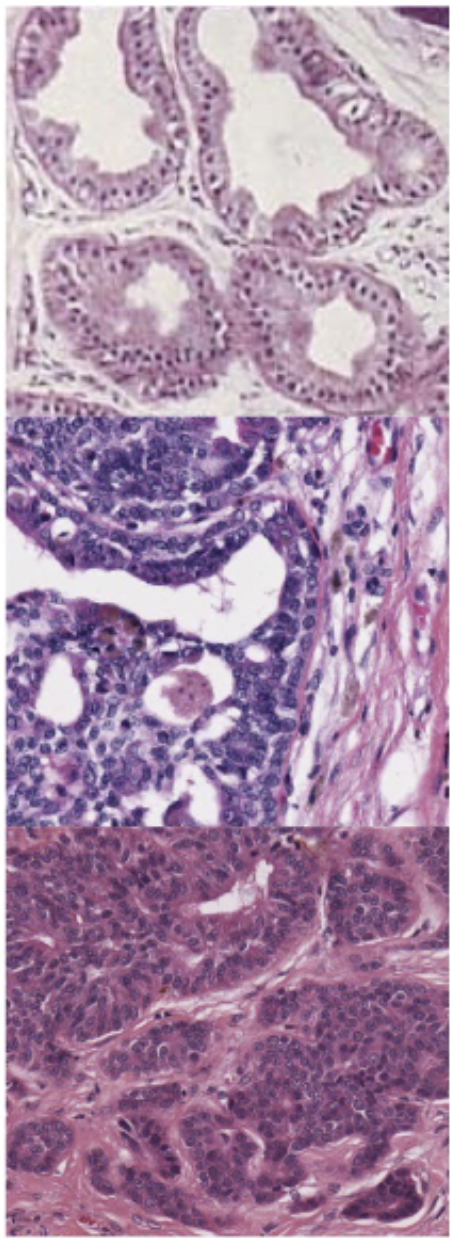 <ul><li><p>Orderly arrangement</p></li><li><p>Uniform cell morphology</p></li><li><p><strong>No cellular atypia</strong></p></li></ul><p></p>