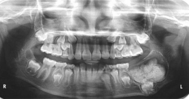 <p>which is NOT in the differential diagnosis</p><p>complex odontoma </p><p>adenomatoid odontogenic tumor </p><p>ameloblastic fibroodontoma </p><p>odontogenic keratocyst </p>