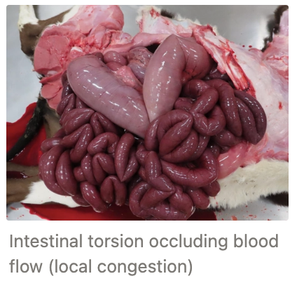 <p><u>Definition:</u> More blood to tissue caused by obstructed flow OUT of tissues at the venous side</p><ul><li><p>Passive process</p></li></ul><p><u>Appearance:</u> Dark red/blue tissues from accumulation of deoxygenated Hb</p><p><u>Types:</u></p><ol><li><p><strong>Localised</strong> = Local restriction of venous flow resulting in a BODY PART with bluish colour</p><ol><li><p>Internal occlusion (eg. thrombus)</p></li><li><p>External compression (eg. tumour, tourniquet)</p></li></ol></li><li><p><strong>Systemic</strong> = Generalised congestion where the whole body is blue as a result of blood pooling in the great veins and affects a wide area of tissue eg. heart failure</p></li><li><p><strong>Hypostatic</strong> = Blood pooling due to the force of gravity (PM examination)</p></li></ol><p><u>Effects:</u></p><ol><li><p>None (gradual onset of local congestion → time to develop adequate collateral circulation through other veins)</p></li><li><p>Oedema</p></li><li><p>Hypoxia and necrosis</p></li><li><p>Ischaemia and infarction</p></li><li><p>Diapedesis or rhexis</p><ul><li><p><strong>Diapedesis</strong> = Passage of blood cells through INTACT capillary walls</p></li><li><p><strong>Rhexis</strong> = Haemorrhage caused by rupture of the vessel wall (usually due to trauma)</p></li></ul></li></ol><p></p>