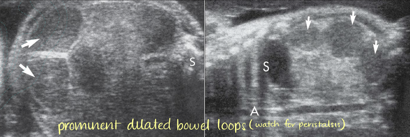 <p>small bowel atresia/obstruction</p>