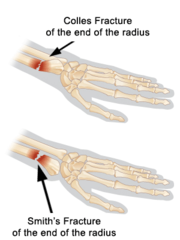 <p>fracture of the distal radius at the wrist</p>