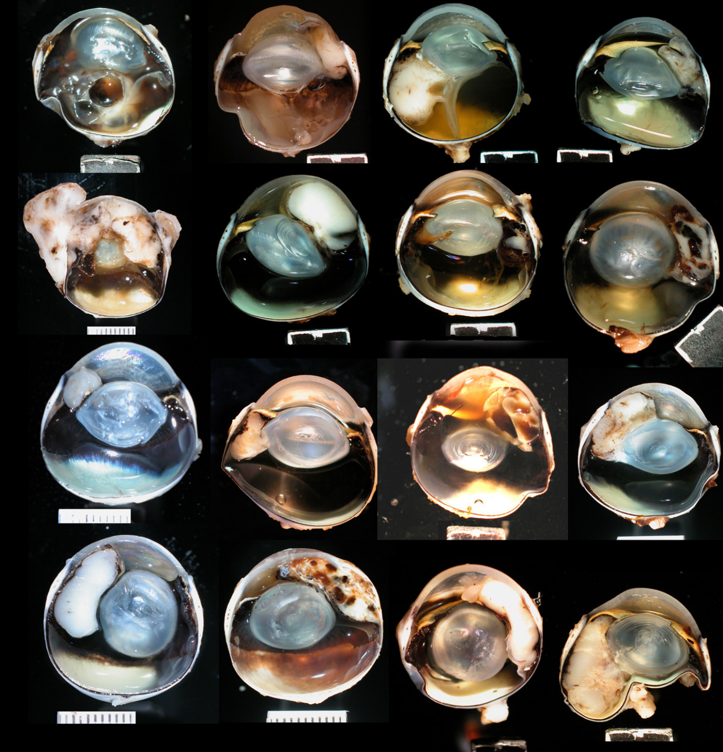 <ul><li><p>mass arises in posterior chamber</p></li><li><p>may extend through the pupil or invade the iris</p></li><li><p>often well vascularized</p></li><li><p>typically <strong>cream-colored mass</strong>; may be partial or completely pigmented</p></li></ul><p></p>