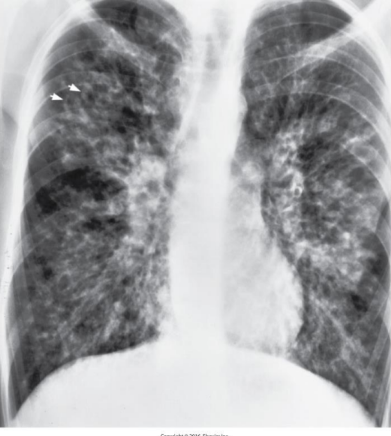 <p>Secretion of excessively viscous (thick) mucus causing severe damage to the lungs, digestive system, and other organs.</p>