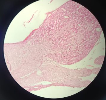 <p>Medulla Spinalis - HE</p><ul><li><p><strong>Organization:</strong> <strong>White matter outside</strong>, <strong>gray matter inside</strong> (butterfly or 'H' shape).</p></li><li><p><strong>Anterior Horn:</strong> Contains very large <strong>alpha motor neurons</strong> that innervate skeletal muscles.</p></li><li><p><strong>Central Canal:</strong> Lined with <strong>ependymal cells</strong> (simple columnar with microvilli/cilia) which produce <strong>cerebrospinal fluid</strong>.</p></li><li><p><strong>Note:</strong> The description is the <strong>same for HE or Silver staining</strong>, but silver clearly shows the cell shape</p></li></ul><p></p>