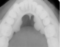 <ol start="61"><li><p>Identify the finding shown.</p></li></ol><p></p>