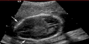 <p>fetal head with bilateral denting of frontal bones </p><ul><li><p>associated with <strong>spina bifida </strong></p></li></ul><p></p>