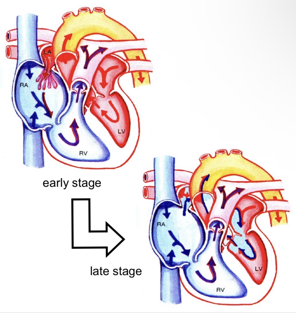 <ul><li><p>Patent foramen ovale remains open </p></li><li><p>Right atrium pressure increases over time </p></li><li><p>Deoxygenated blood enters left atrium → hypoxia</p></li></ul><p></p>
