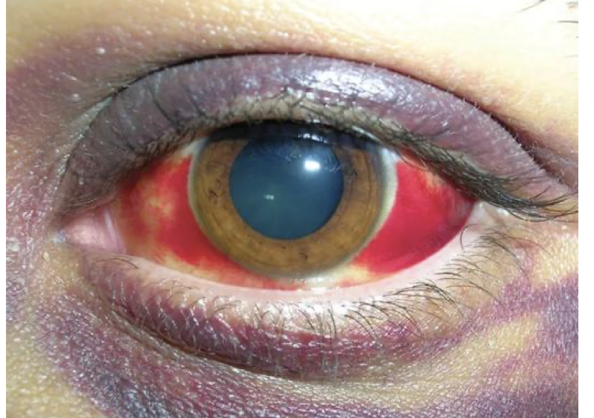 <ul><li><p>blunt blow to the eye</p></li><li><p>causes collection of blood in anterior chamber of eye</p></li><li><p>vision is partially or completely blocked</p></li></ul><p></p>
