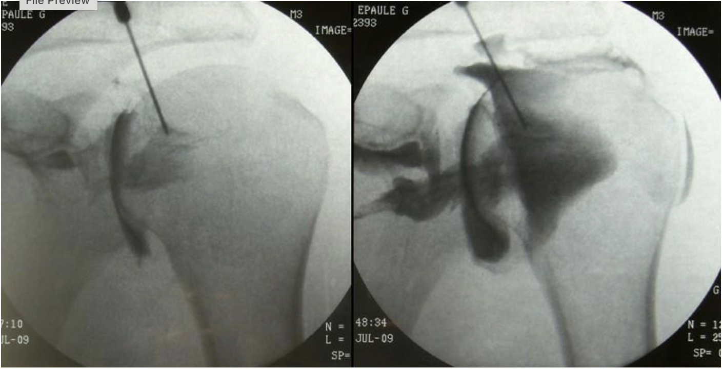 <p>what procedure is being performed</p>