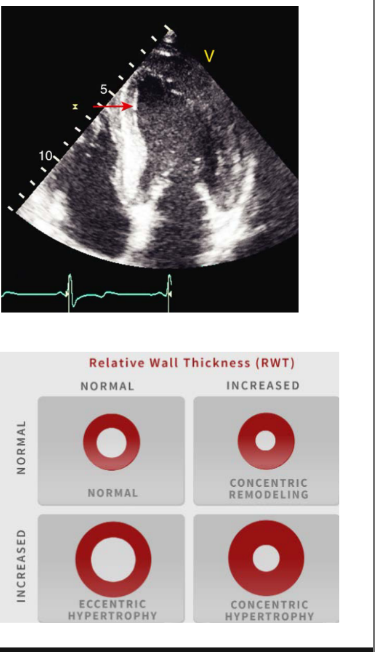 <ul><li><p>Concentric LV hypertrophy (increased wall thickness, increased mass)</p></li><li><p>Thickened papillary muscles</p></li><li><p>Initial preserved LV systolic function</p></li><li><p>Grade II diastolic dysfunction</p></li><li><p>“Bilayered” appearance of the endocardium</p></li><li><p>Inferolateral strain impairment with severe LA strain impairment</p></li></ul><p></p>