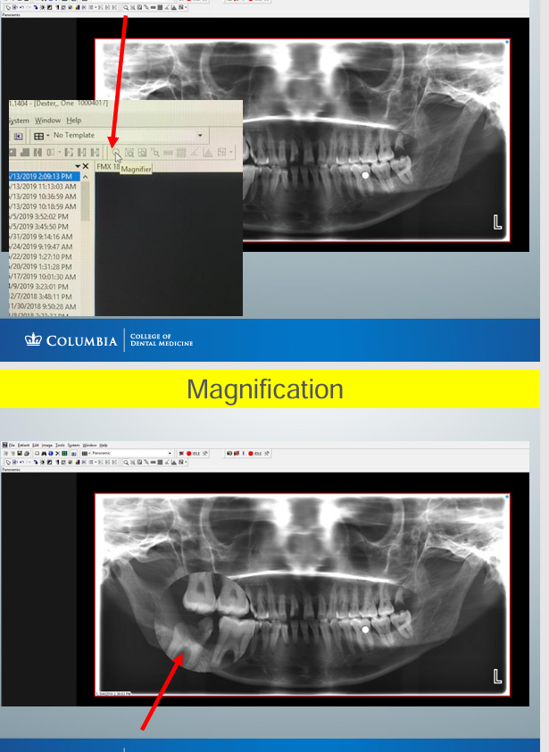 <p>-place the magnifier on the image to zoom the area of interest with a left click</p><p>-do NOT save modification in MiPACS</p><p>-need to save the original images</p>