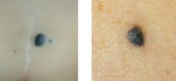 <p>Blue Nevus</p>
