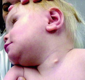<p><span>brachial cleft cyst</span></p>