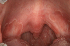 <p>erythematous patches surrounded by white/ yellow serpentine borders </p>