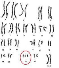<p>a condition in which an extra copy of a chromosome is present in the cell nuclei, causing developmental abnormalities</p>