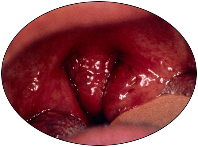 <p>What condition is shown in this picture?</p>