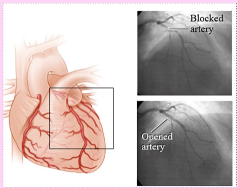 <p>also known as a heart attack; prolonged coronary blockage; areas of cell death are repaired with noncontractile scar tissue</p>