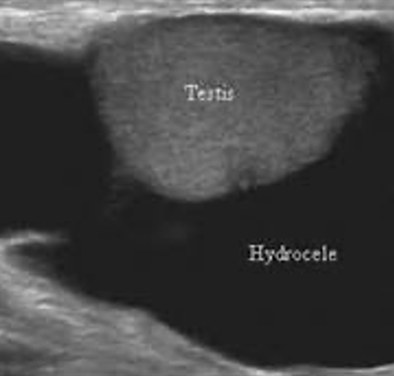 <p>scrotal ultrasound</p>