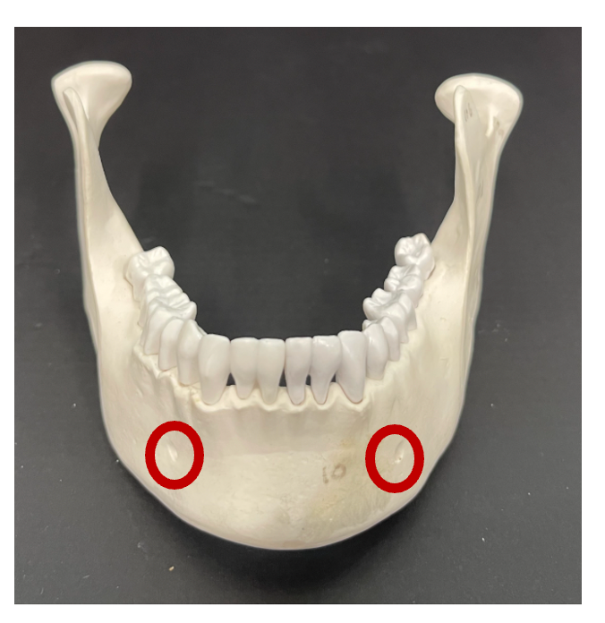 <p>What is the name of the foramen that is encircled in the image below?</p>