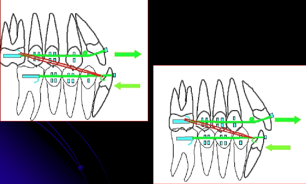 <p>ID the elastics class:</p><p>- Connects mandibular teeth that are more anterior to maxillary teeth that are more posterior</p>